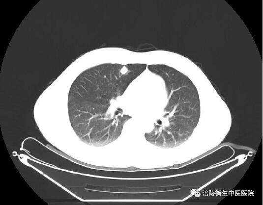 涪陵衡生中医医院 连续成功开展3例胸腔镜下肺癌根治术